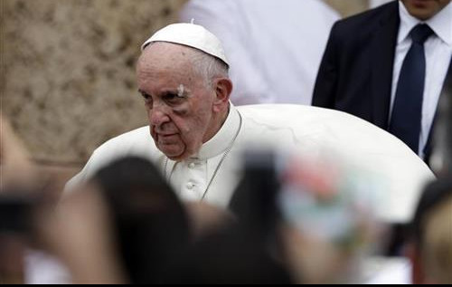 (FOTO) KOLUMBIJA: Papa se povredio, ima modricu na obrazu!
