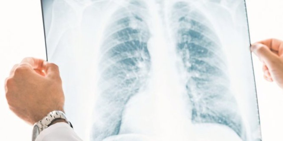 Ovo su znakovi da imate upalu pluća! Povremeno može da se javi i ovaj simptom koji ne smete da ignorišete