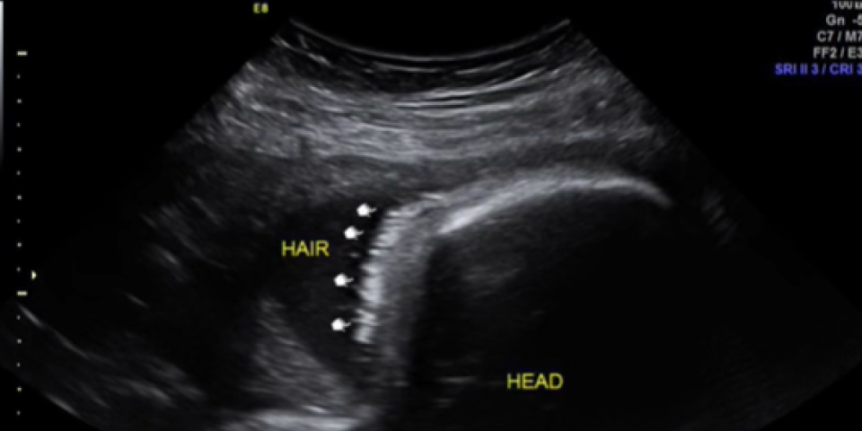 Otišla je na ultrazvuk i ugledala crnu tačku na monitoru! Kada su majci lekari otkrili šta je u pitanju, zanemela je od šoka (VIDEO)
