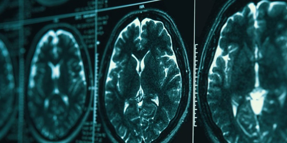 Može li se mozak "podmladiti"? Vaskularni hirurg otkriva kako sprečiti moždani udra