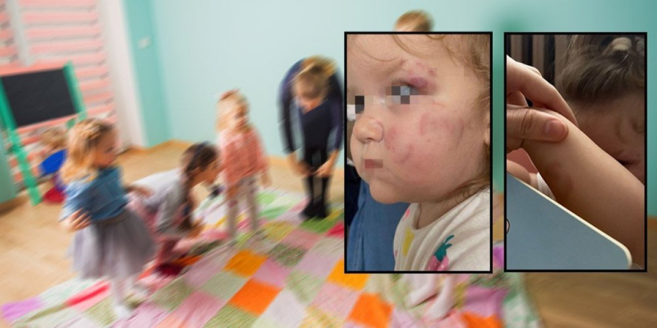 Dete izujedalo vršnjakinju u vrtiću! Devojčica sa ozbiljnim povredama hitno primljena u bolnicu: Horor u Smederevu (FOTO)