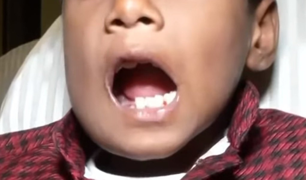 (VIDEO) ČUDO NEVIĐENO! DEČAKU IZVADILI 526 ZUBA! Sedmogodišnjak u vilici imao rekordan broj zuba nalik BISERIMA