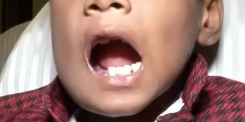 (VIDEO) ČUDO NEVIĐENO! DEČAKU IZVADILI 526 ZUBA! Sedmogodišnjak u vilici imao rekordan broj zuba nalik BISERIMA