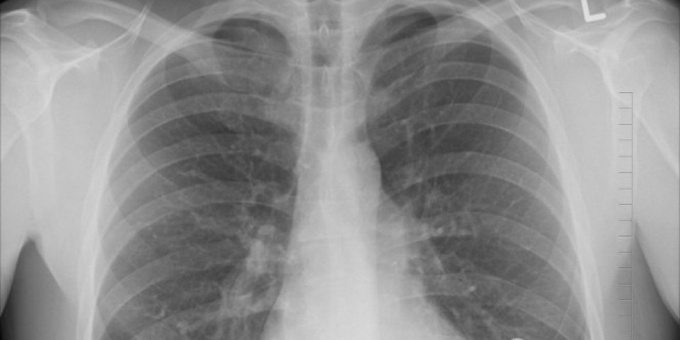 U Turskoj otkriven neobičan oblik kovida - lekari mislili da čovek ima rak pluća, a onda je usledio šok!