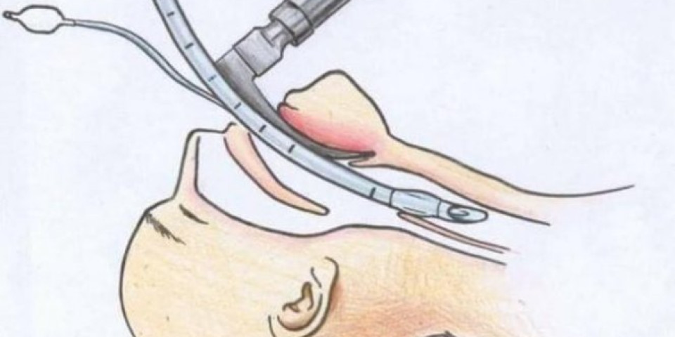 ZA ONE KOJI NE RAZUMEJU KAKO JE BITI NA RESPIRATORU! Šok OBJAŠNJENJE potreslo GRAĐANE - Ove pacijente čeka SMRT!