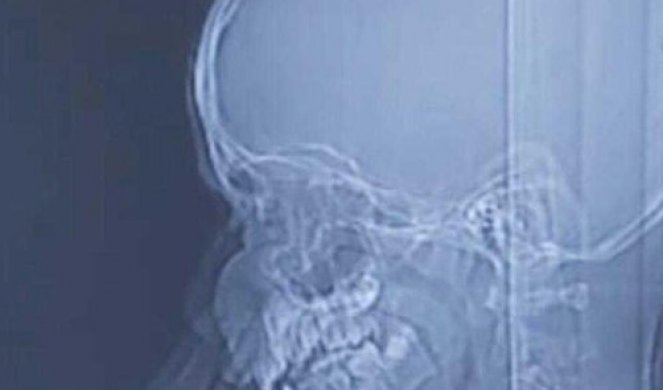 DEČAK IZNENADA POSTAO POSPAN, lekari se šokirali kad su mu uradili skener glave!