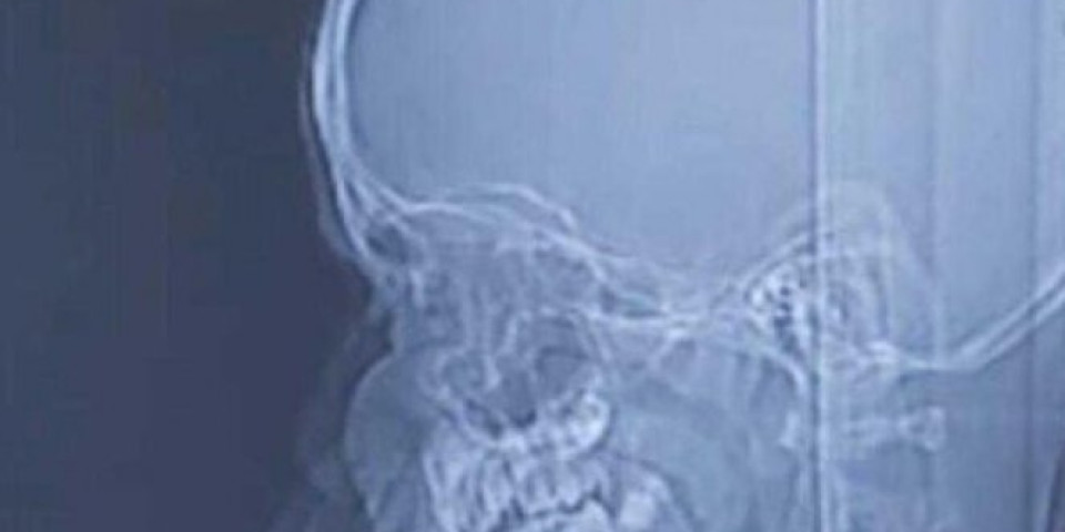 DEČAK IZNENADA POSTAO POSPAN, lekari se šokirali kad su mu uradili skener glave!