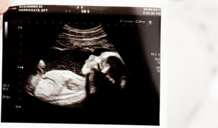 Trudnica otišla na pregled, a ono što je doktor video na ultrazvuku JU JE ŠOKIRALO! Nosila je blizance, ali je jedan bio MLAĐI OD DRUGOG ČAK 3 NEDELJE! NEVEROVATAN FENOMEN! /Foto/