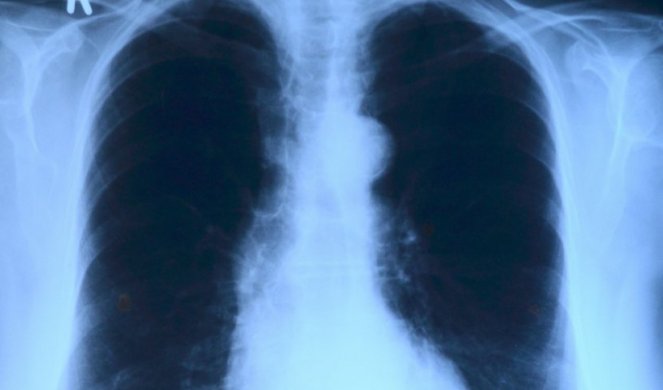 Dr Stevanović objavio snimak pluća obolelog, jedan jezivi detalj otkrio šta korona radi našem telu!