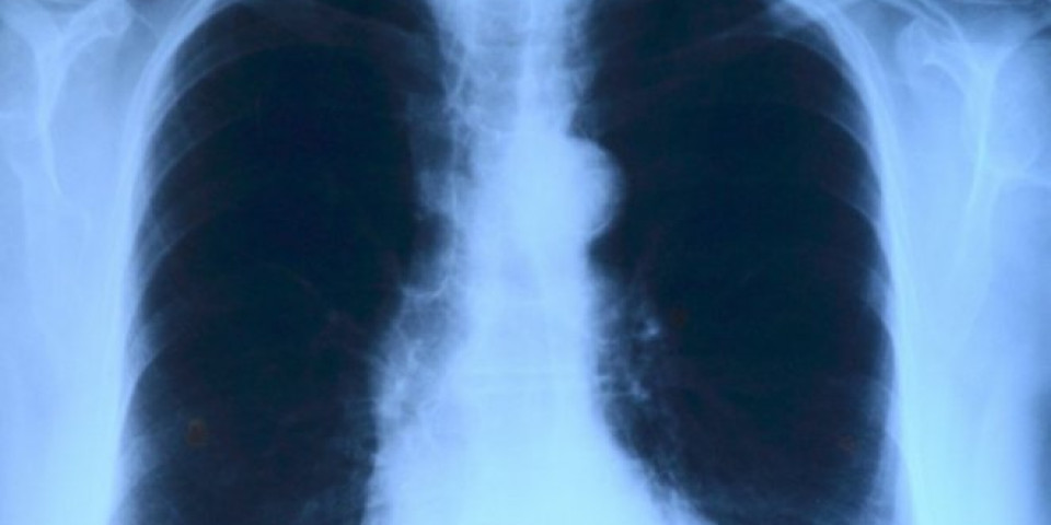 Dr Stevanović objavio snimak pluća obolelog, jedan jezivi detalj otkrio šta korona radi našem telu!