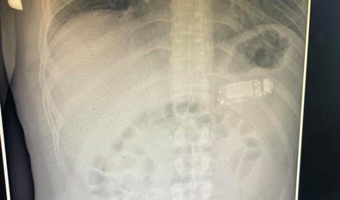 Lekari u Prištini nisu mogli da veruju šta vide u stomaku pacijenta: Plašili smo se da ne eksplodira u crevima...