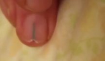 Evo KAKO da izvadite TRN koji se zaglavio pod noktom! Doktor upozorava na jednu BITNU STVAR! (VIDEO)