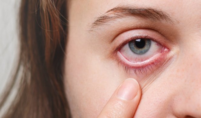 NIJE SAMO OD PROMAJE ILI UMORA! Crvenilo očiju može ukazivati na OVIH  5 ZDRAVSTVENIH PROBLEMA!