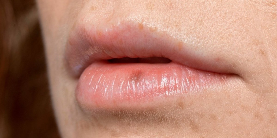 Izlečite sami herpes na usni! Ovih 7 prirodnih lekova će vam pomoći u tome