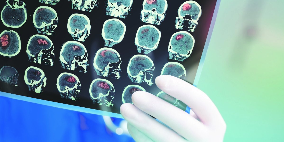 Šlog kosi i mlade! Svake godine u Srbiji više od 25.000 ljudi doživi moždani udar - Alarmantni podaci!