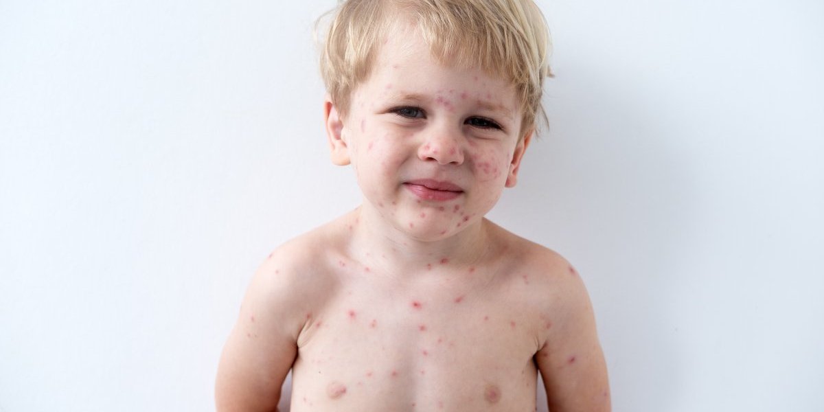 Dečak (8) zaražen morbilama nikad nije primio nijednu vakcinu! Lekari šokirani: Sada se proverava jedna stvar!