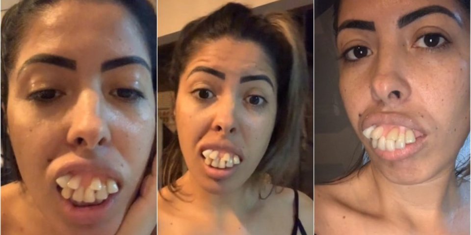 Svi u šoku gledali njene ogromne "kljove"! Žena pokazala transformaciju zuba, pa otkrila zapanjujuću istinu (VIDEO)