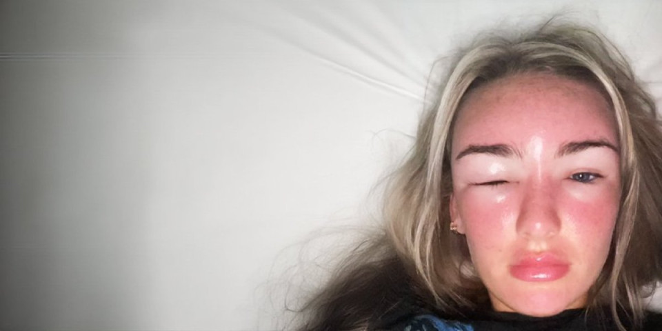 Strašne posledice trovanja suncem! Otečene oči i gubitak vida samo su početak agonije, devojka jedva izvukla živu glavu (VIDEO)