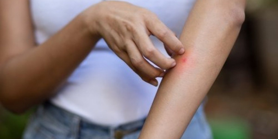 Jedan znak na koži otkriva sve: Prepoznajte opasne ujede insekta - evo kako da znate šta vas je napalo