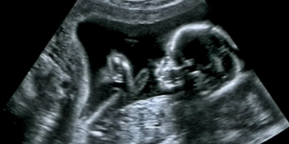 Rođena beba sa četiri ruke i noge i dva lica! Lekari zanemeli od šoka