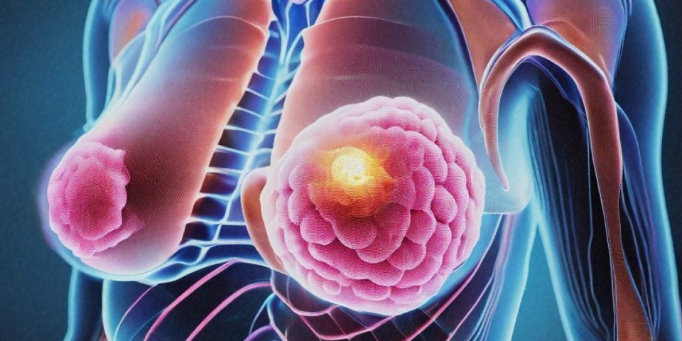 Otkrivena slaba tačka agresivnog raka dojke: Poznati lek usporio metastaze - Naučnici oduševljeni