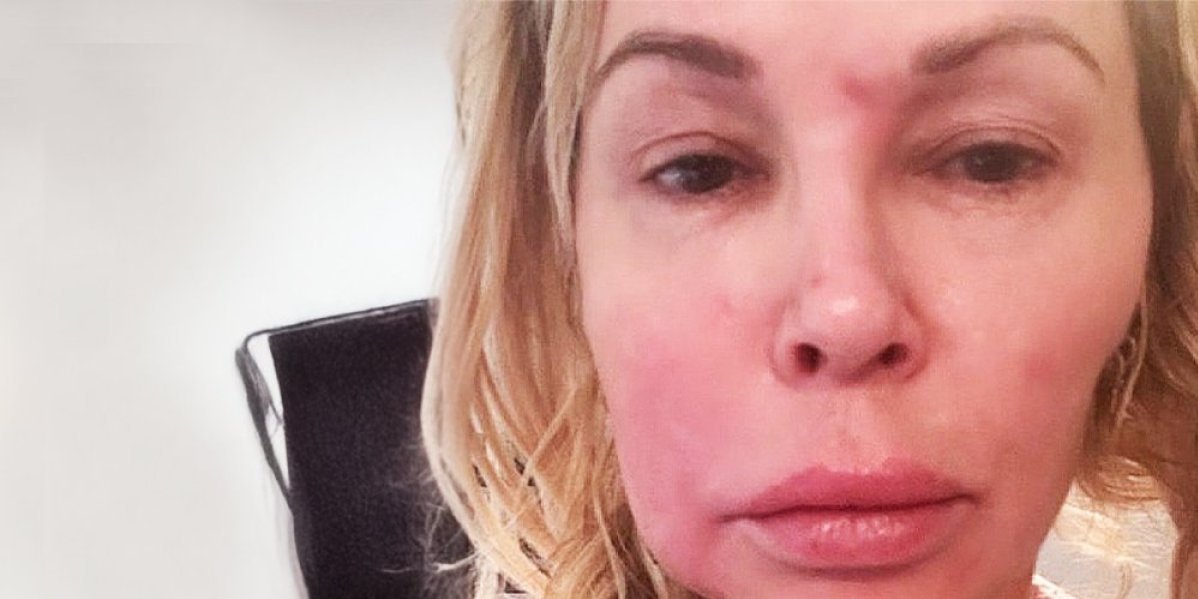 Parazit joj se razmnožava u licu! Jedna strana face joj se topi - horor priča obišla svet (VIDEO)