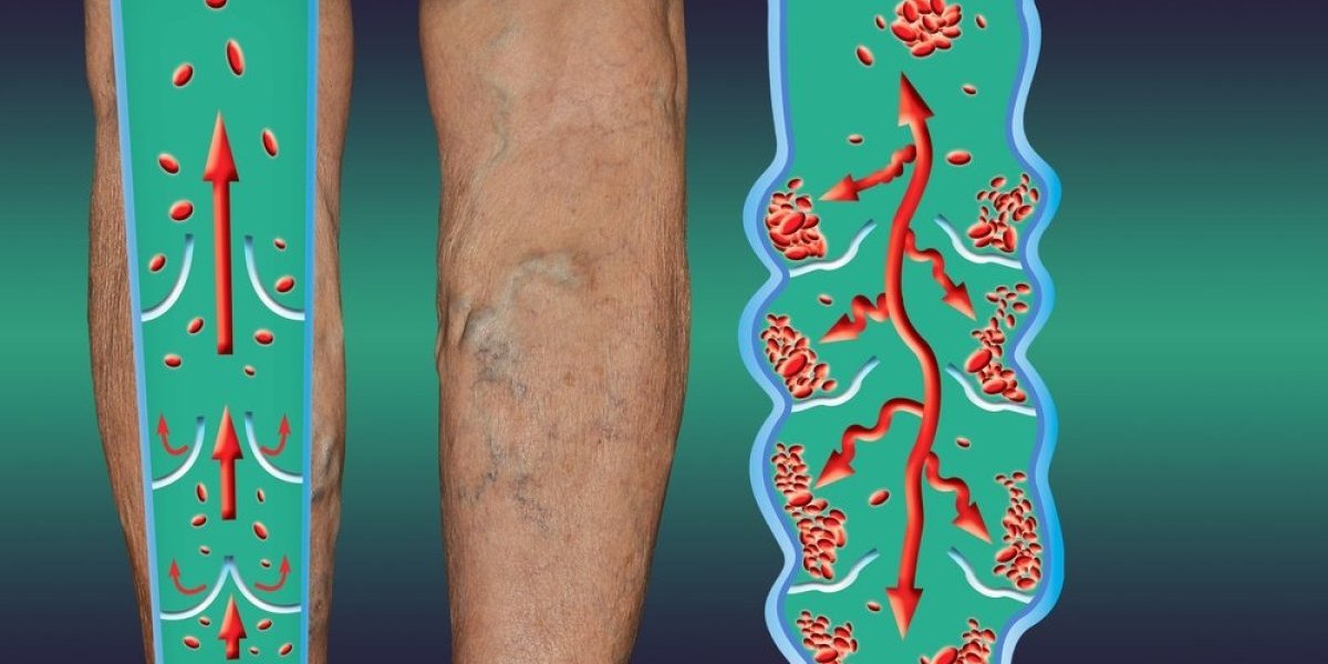 Ruska kaša koja razbija tromb: Prirodni recept spas za proširene i upaljene vene