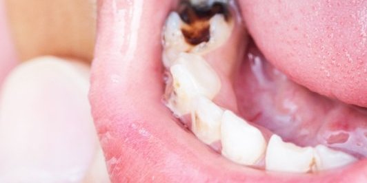 Suludi Tik Tok trend zaludeo mlade u Srbiji: Nećete verovati za šta koriste lampu za nokte - Posledice su katastrofalne