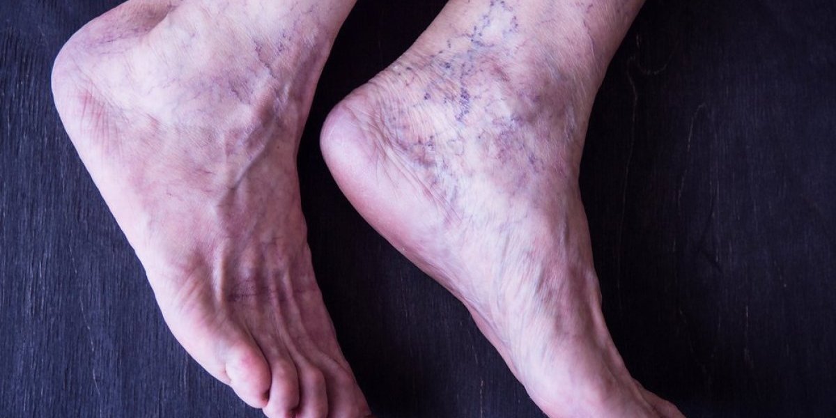 Ovu tabletu miloni uzimaju, a tempirana je bomba: Milslila je da joj noga plavi zbog rada od kuće, ali to je bio znak katastrofalnog stanja