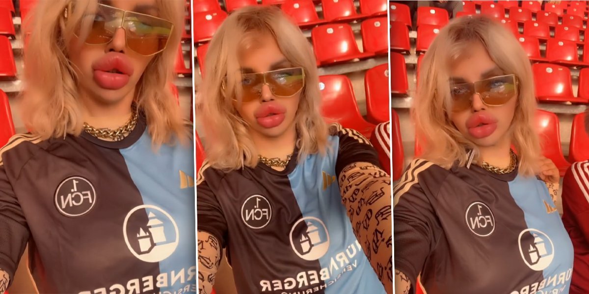 Svake nedelje dodaje filere u već ogromne usne - Jedva diše od njih, ali ne namerava da stane (VIDEO)