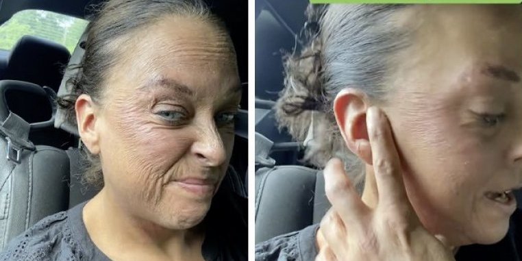Preparat koji žene obožavaju joj spalio kožu: Dobila je rane i žuljeve, izgleda kao da ima 80 godina (VIDEO)