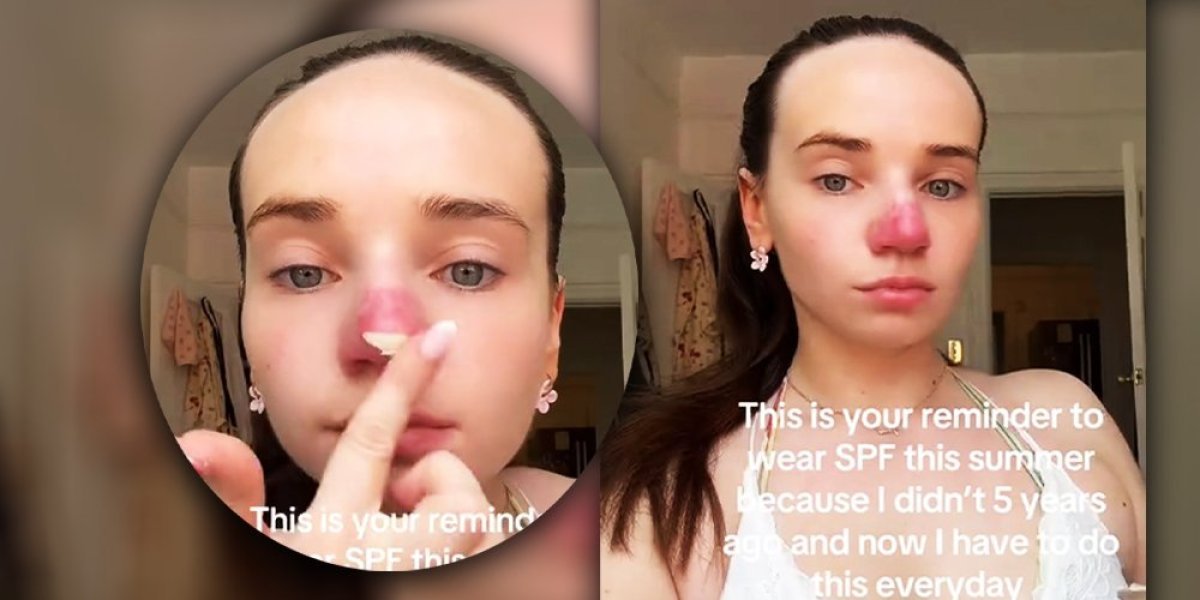 Zadremala na suncu i doživela pakao: Ni posle 5 godina nema dijagnozu, lekari od nje digli ruke (VIDEO)