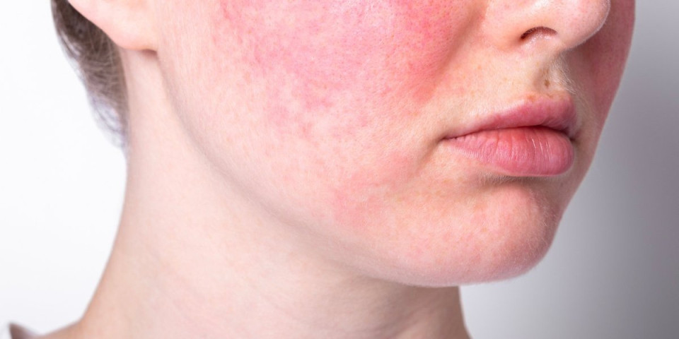 Rešite se crvenila na licu: 3 ključna koraka kako da umirite i oporavite kožu