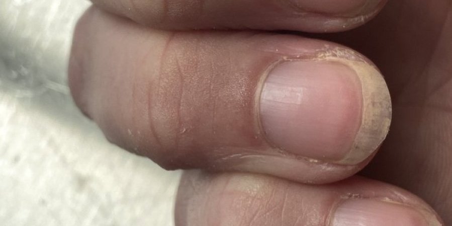 Promena na noktu znak smrtonosnog raka: Otišla na pregled i saznala najgore vesti - život joj postao horor