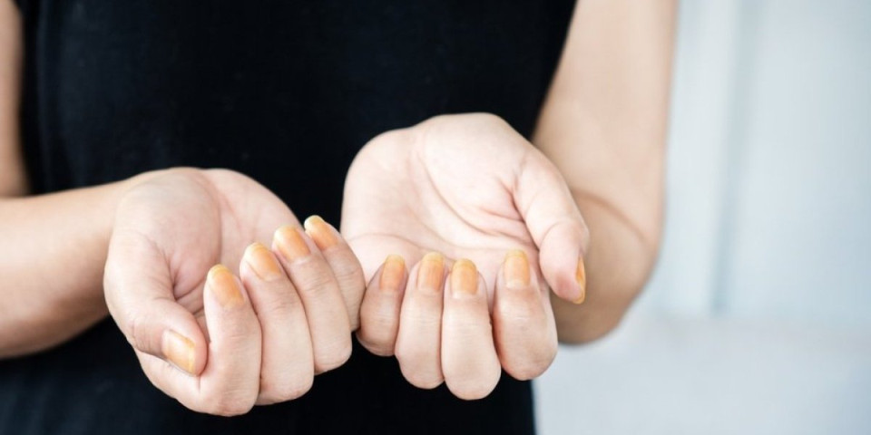 Promena boje noktiju može da vas ubije: Proverite ih pre nego što bude kasno