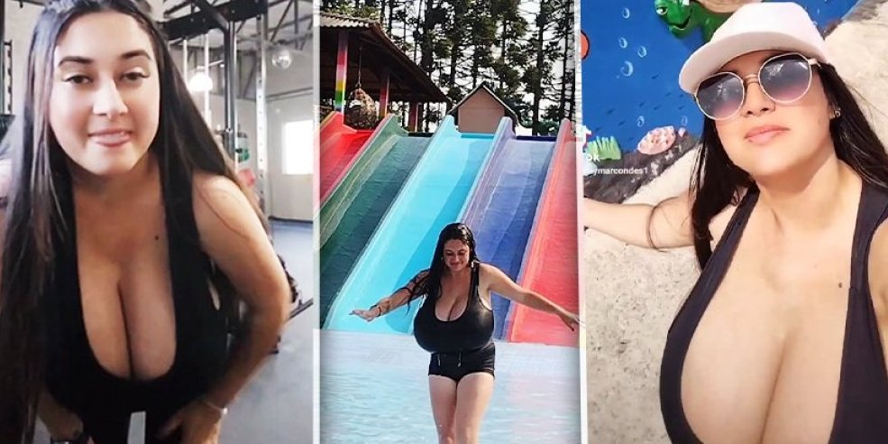 Zbog gigantskih grudi morala da koristi kolica: Život postao nepodnošljiv, trpela bolove i nije mogla da hoda (VIDEO)