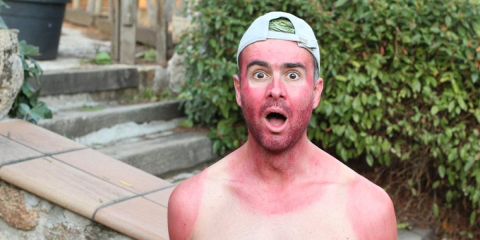 Takmičenje u opekotinama od sunca – Sprdnja ili zastrašujuća stvarnost? Ceo svet priča o ovome (VIDEO)