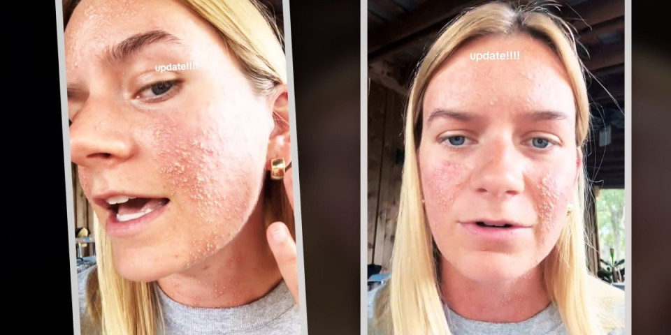 Insekt je ujeo za zadnjicu i lice je počelo da joj gori: Probudila se sa plikovima, jedva izvukla živu glavu (VIDEO)