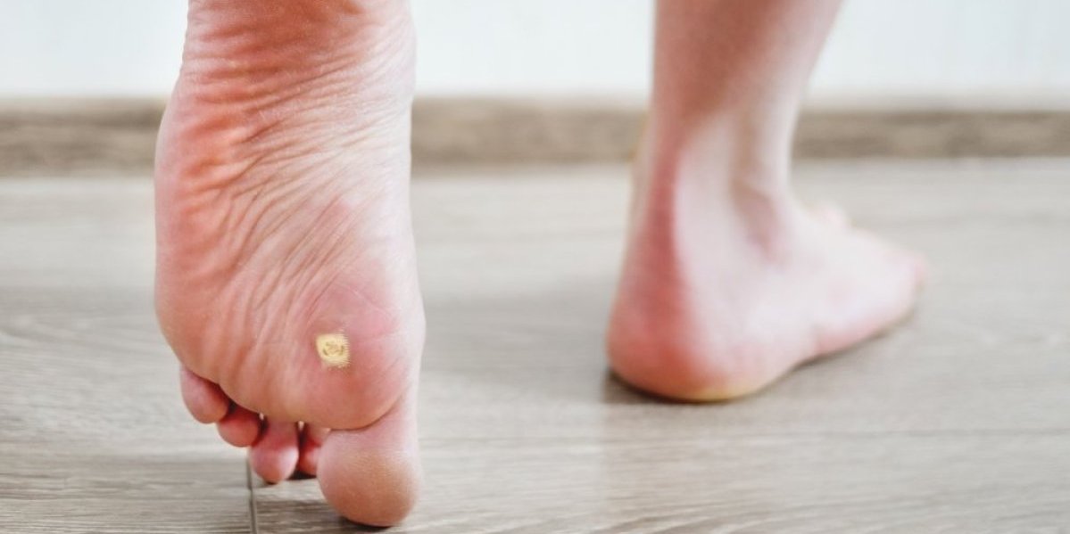 Kurje oko nestaje kao gumicom: Ovo su recepti koje su koristile naše bake