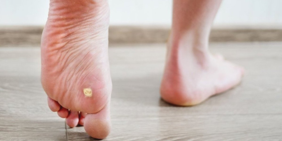 Kurje oko nestaje kao gumicom: Ovo su recepti koje su koristile naše bake