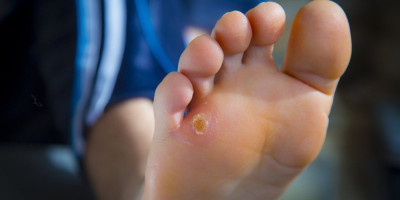 Jedan jednostavan prirodan recept može da pomogne oko kurjeg oka i žuljeva, a uključuje samo čuvarkuću i flaster.