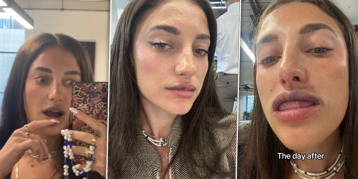 Usne su joj bile crne i modre: Otopila je filer iz usana i potpuno se unakazila (VIDEO)