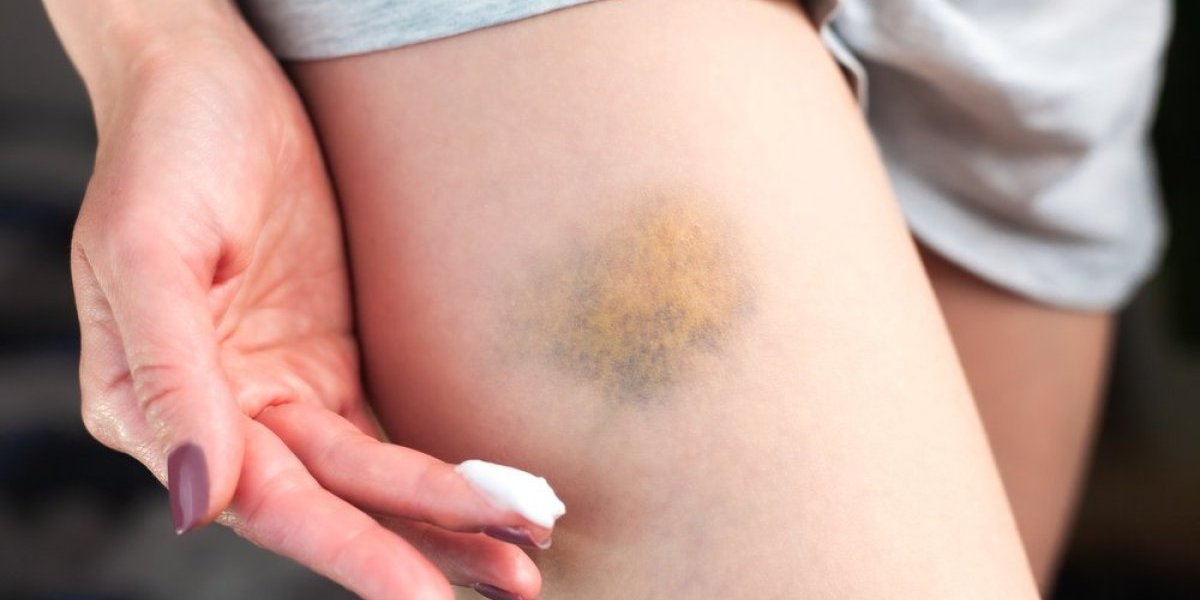 Briše modrice kao gumicom: Maska od ove biljke je prirodno čudo, a lako se pravi