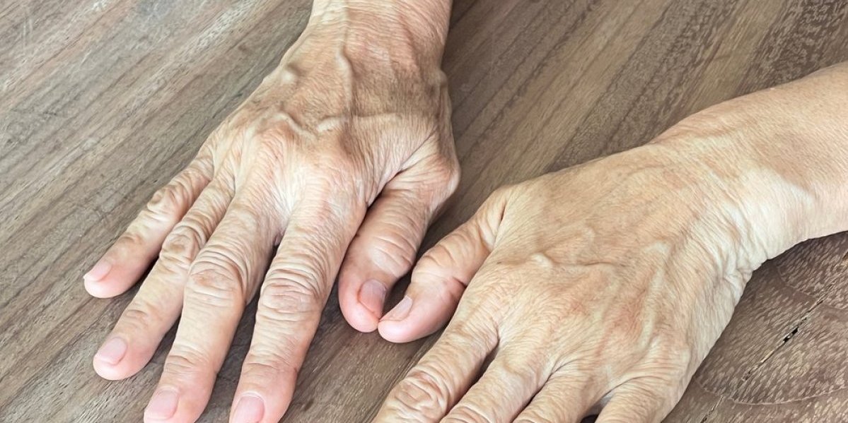 Ispupčene vene na rukama nisu bezazlene: Evo na šta ukazuju i kada je vreme za alarm