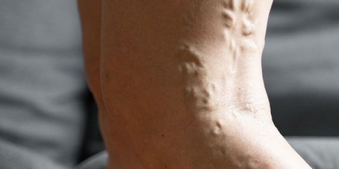 Proširene vene: Dve namirnice koje vas mogu spasiti ove "napasti" - A svi ih imamo u kući (FOTO)