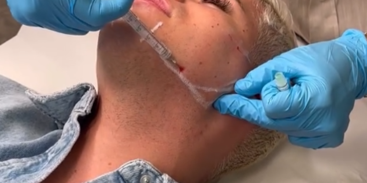 Uroš Stanić na korekciji celog lica