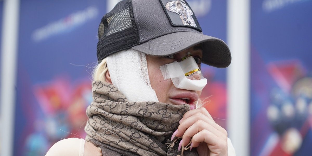 "Hitno da tuži hirurga zbog njonje": Nos Dušice Jakovljević se skroz deformisao (VIDEO)