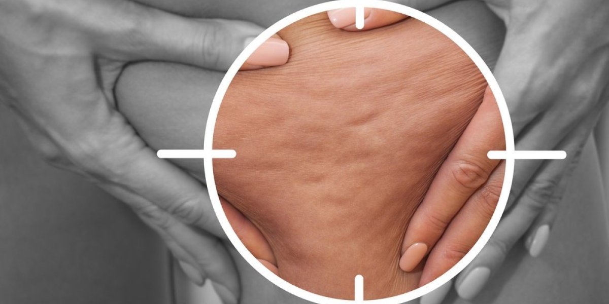 Kućni aparat koji eliminiše celulit: Pegla pomorandžinu koru kao peglom (VIDEO)