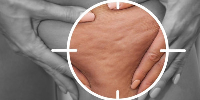 Jedna žena otkrila je tajnu na Tiktoku kako uz pomoć ručnog usisivača uklanja celulit.