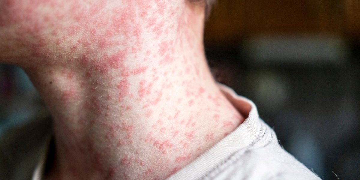 Sve o tifusu: Zaraza se brzo širi, prvi simptomi se pojave tek posle 7 dana - Ishod može biti fatalan